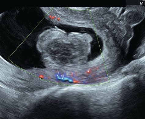 Using ultrasound, a pregnancy is declared nonviable based on the following definitive criteria: A gestational sac that contains no embryo but has a mean diameter of 25 millimeters or greater. A gestational sac with a yolk sac is observed in a scan but, 11 or more days later, there is no embryo with a heartbeat.